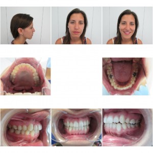 Especialistas en invisalign Clinica Mariana Sacoto Navia Ortodoncia Transparente sin hierros