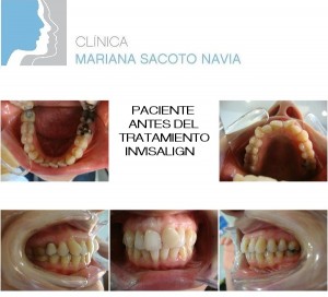 Clínica Mariana Sacoto Navia Ortodoncia Invisible Barcelona Expertos en Invisalign