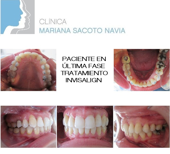 Clinica Mariana Sacoto Navia Ortodoncia Invisible Barcelona Expertos en Invisalign