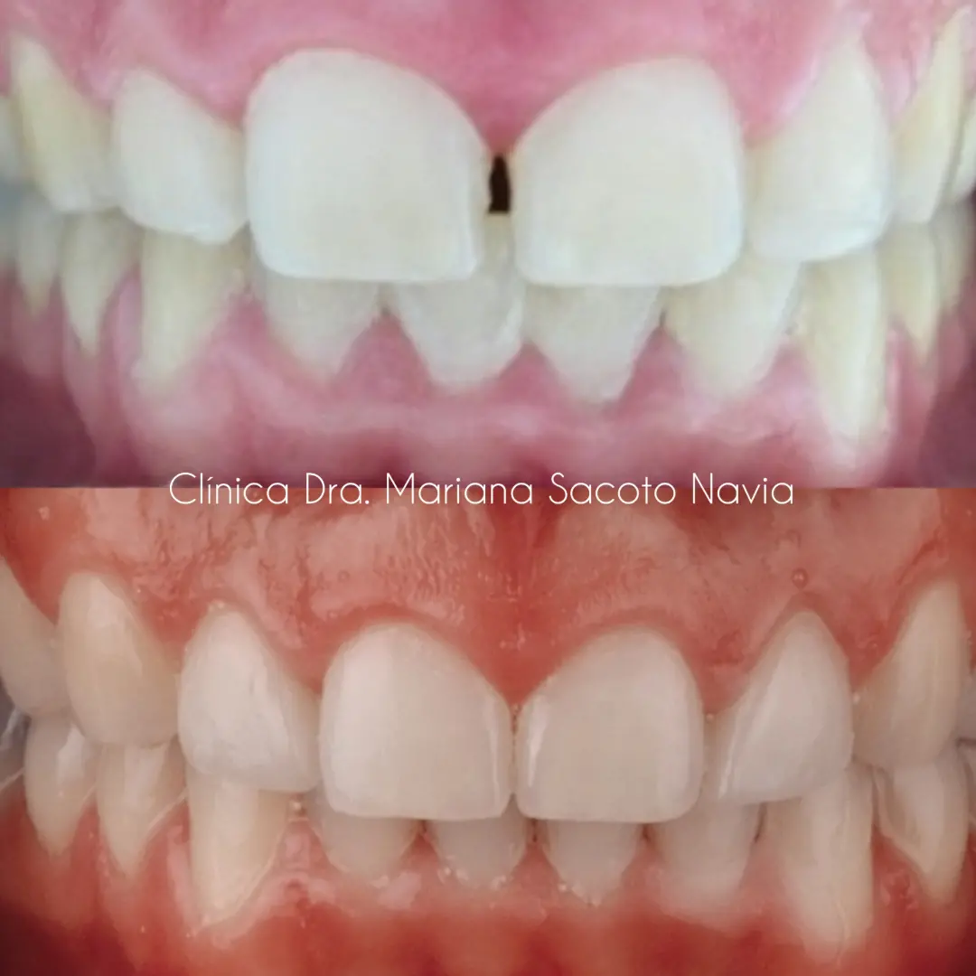 Ortodoncia Invisible Invisalign expertos en ortodoncia Invisible Digital Doctora Mariana Sacoto Navia Experiencia Calidad Seguridad